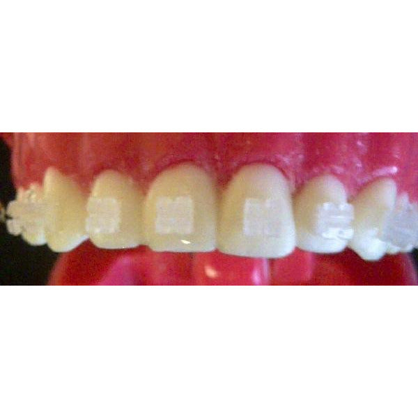 Cx Ceramic .022 MBT Hooks on 3's (partial set)